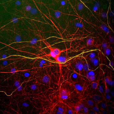Immunocytochemical staining of mouse brain cortical neurons in culture. NFL immunoreactivity is red and yellow. Blue staining is DAPI nuclear staining. Anti-NFL (1:1000 dilution). Dr. Felix Eckenstein, University of Vermont.