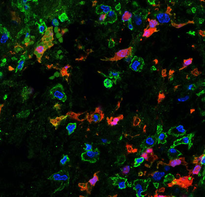 Immunolabeling of MBP (red, 1:200), CD45 (green, 1:100), and DAPI (1:1000, nuclei) of a mouse spinal cord lysophosphatidylcholine lesion. Image kindly provided by Charbel Baaklini, Neuroscience and Mental Health Institute, University of Alberta, Edmonton, Canada
