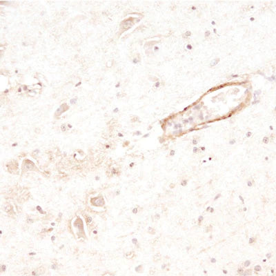 Immunohistochemistry of a capillary showing beta-amyloid peptide in the wall of the vessel. Paraffin-embedded section of a human brain from a patient with diagnosed Alzheimer's Disease. Primary antibody -- 1:500; secondary antibody -- 1:1000 HRP-Goat anti-chicken IgY (Aves Labs). Dr. Randy Woltjer, Dept Pathology, OHSU