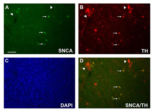 Chicken anti-SNCA (green) and TH (red) double immunostaining in Parkinson's Disease patient’s substantia nigra section. Arrows indicate SNCA positive, degenerating dopamine neurons. Arrowheads indicate SNCA negative, healthy dopamine neurons. Bar = 50 um for A-D. (Image courtesy of Dr. Curt Freed’s lab, University of Colorado Anschutz Medical Campus.)