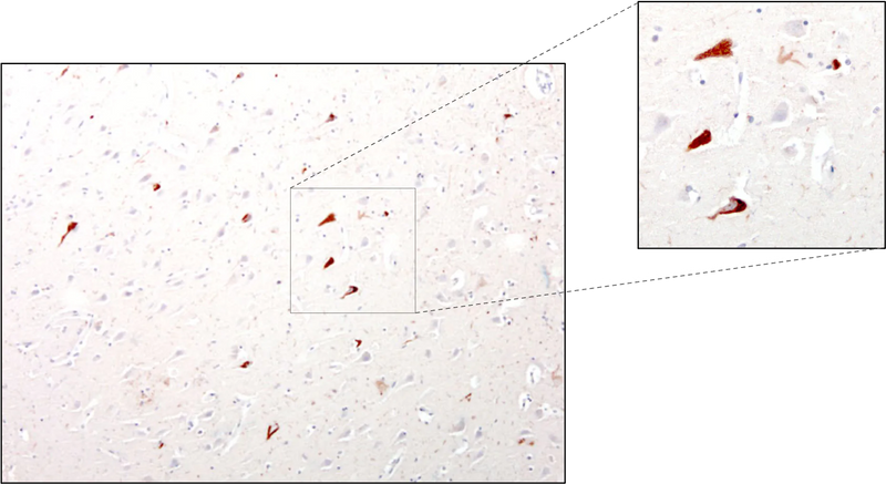 Immunohistochemical presence of tau in neurofibrillary tangles in cortical neurons of an Alzheimer's Disease patient. Anti-Tau antibody (1:10,000) was incubated with formalin-fixed, paraffin-embedded sectioned material from Alzheimer's brains. Primary antibody was visualized with HRP-labeled goat anti-chicken IgY. Dr. Randy Woltjer, Oregon Health & Sciences University.