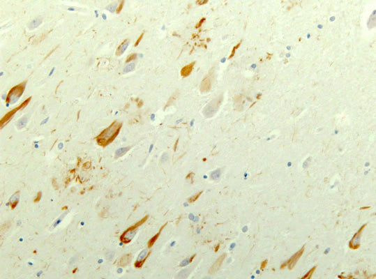 Immunohistochemical presence of tau in a neurofibrillary tangle in cortical neurons of an Alzheimer's Disease patient. Anti-Tau antibody (1:10,000) was incubated with formalin-fixed, paraffin-embedded sectioned material from Alzheimer's brains. Primary antibody was visualized with HRP-labeled goat anti-chicken IgY. Dr. Randy Woltjer, Oregon Health & Sciences University.
