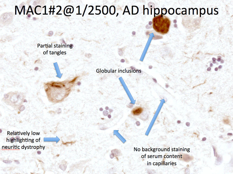 Frame showing MAC-1 immunoreactivity in human microglial cells in an Alzheimer's Disease patient. Photomicrograph taken by Dr. Randy Woltjer, Pathology, OHSU.